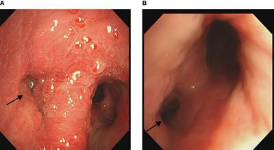 Case report: Bronchoscopic intervention for rare benign airway tumors: a report of 4 cases and literature review